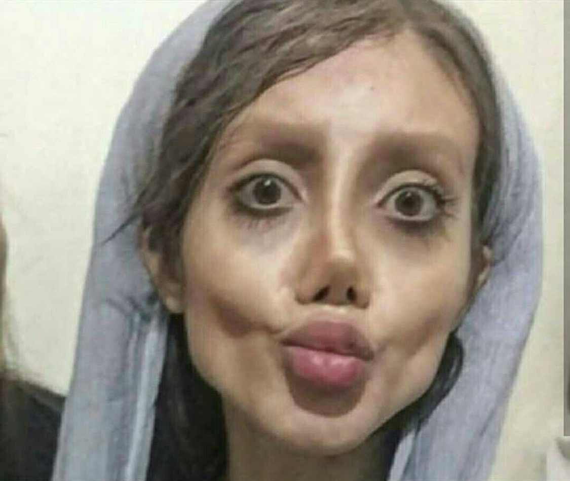Teen’s plastic surgery to look like Angelina Jolie goes